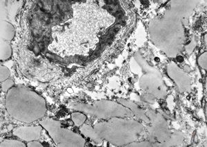 M,35y. | duodenum … lipid malabsorption - susp. hypo-beta-lipoproteinemia